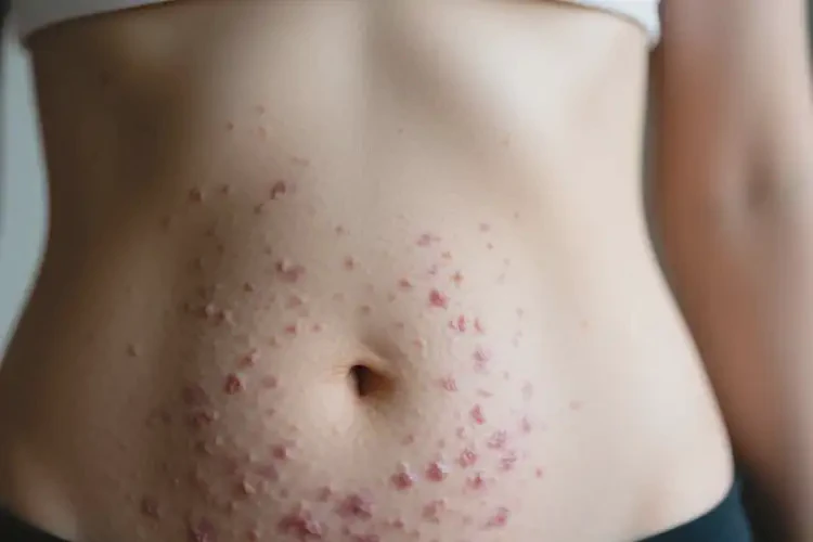 女生肚子上有濕疹不管它會自己痊愈嗎(圖1)