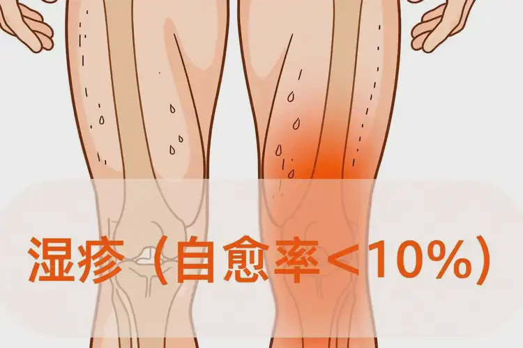 男性大腿上出濕疹可不可以徹底自愈(圖1)