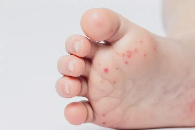 兒童腳上偶爾起濕疹不管它會(huì)自己好嗎(圖4)