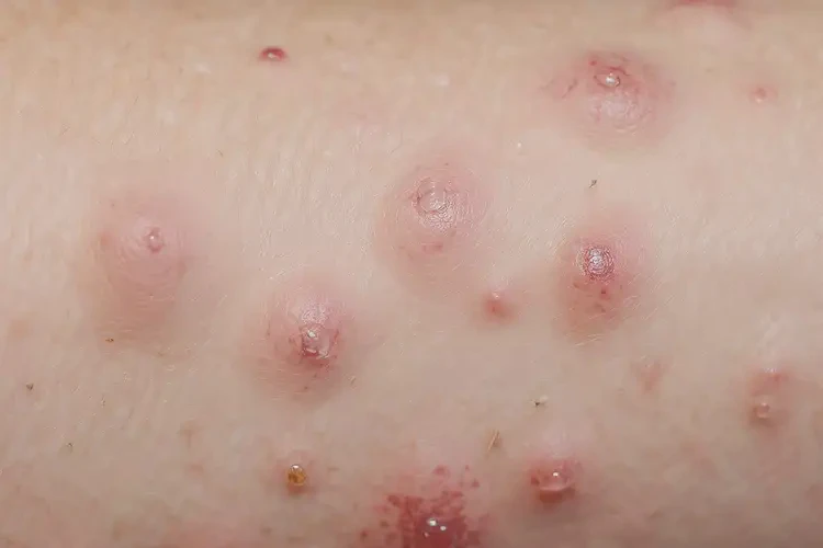 女人屁股上出湿疹不管它会自己好吗(图3)