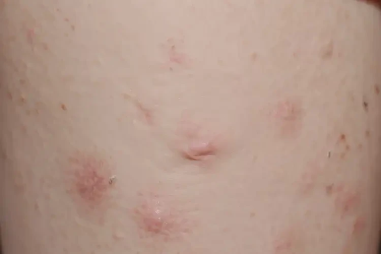 青少年大腿上經(jīng)常長(zhǎng)濕疹不管它會(huì)自己痊愈嗎(圖4)