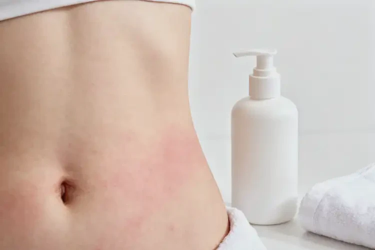 女生肚子容易長濕疹不管它會自己痊愈嗎(圖3)