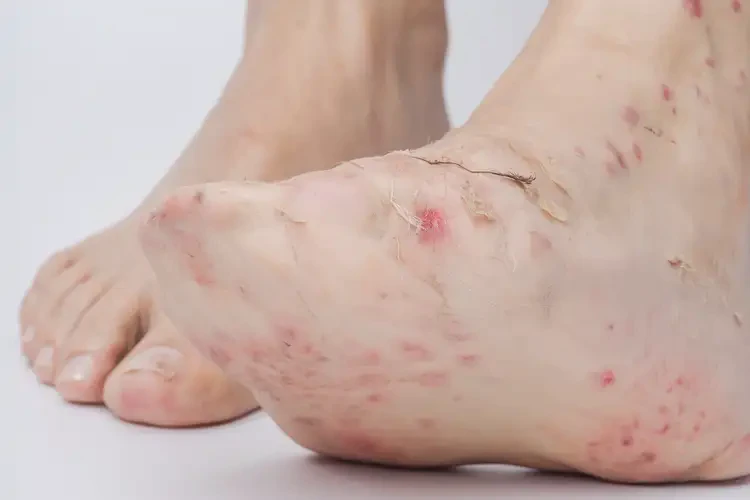 女生腳上經(jīng)常起濕疹能靠自己自愈嗎(圖4)