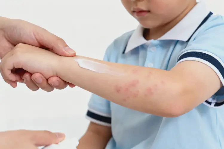 小學(xué)生手臂上出濕疹可不可以徹底自愈(圖1)