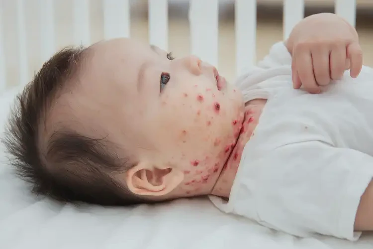 嬰幼兒脖子有濕疹能靠自己自愈嗎(圖4)