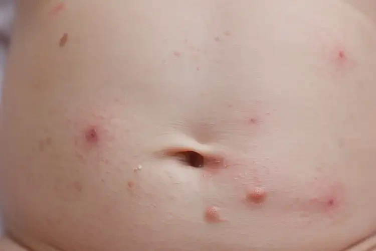 新生兒肚子經(jīng)常長(zhǎng)濕疹可不可以徹底自愈(圖4)