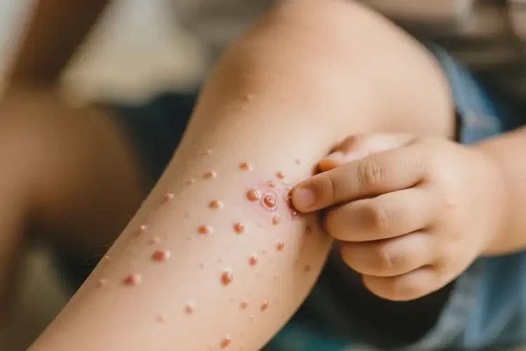 少兒小腿經(jīng)常長濕疹不管它會自己痊愈嗎(圖3)