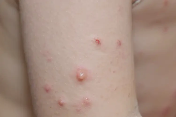 小孩手臂上長濕疹可以徹底自愈嗎(圖4)