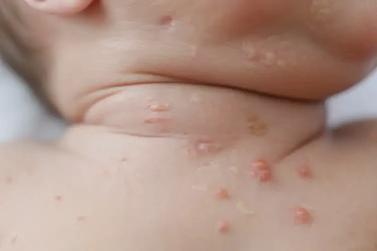 新生兒脖子上偶爾長濕疹不管它會自己好嗎(圖4)