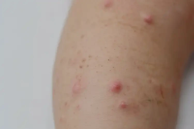 少兒小腿上出現(xiàn)濕疹不管它會(huì)自己好嗎(圖3)