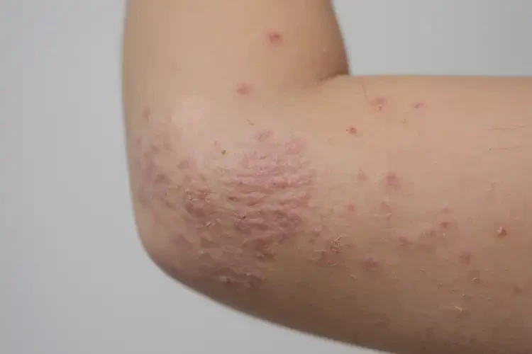 孩子手臂經(jīng)常起濕疹可不可以徹底自愈(圖4)