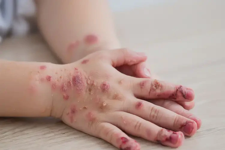 小兒手上出濕疹不管它會自己自愈嗎(圖2)