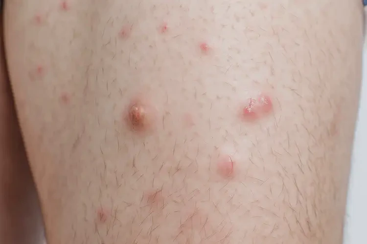 青年人大腿上偶爾長濕疹不管它會(huì)自己痊愈嗎(圖4)