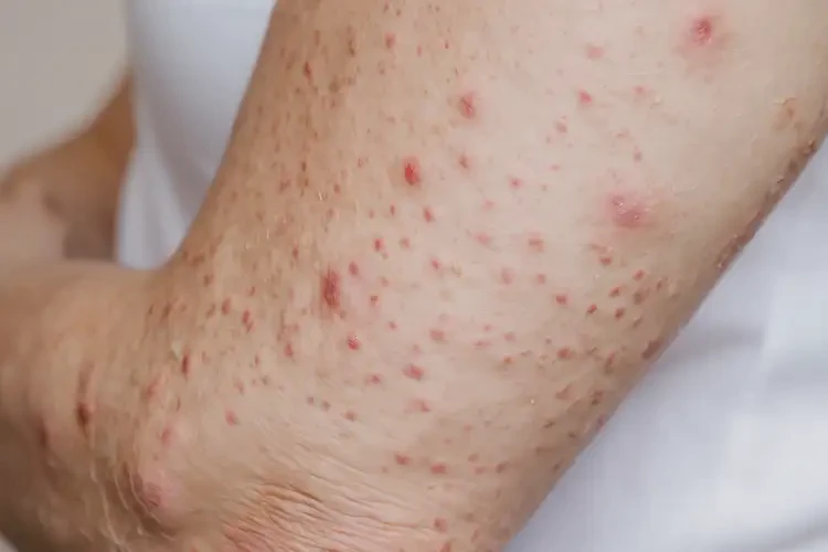 女性手臂長濕疹能徹底自愈嗎(圖4)