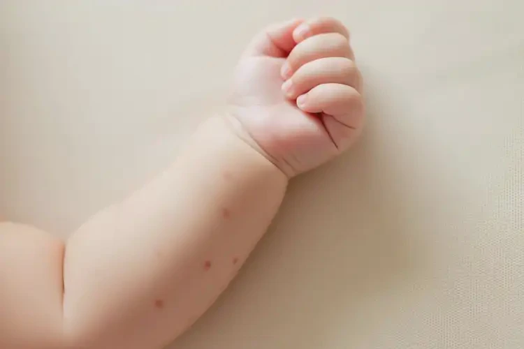 嬰兒手臂偶爾長濕疹不管它會自己好嗎(圖3)