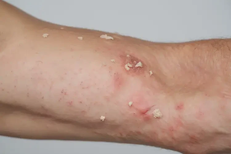 男生手臂上偶爾長濕疹可以徹底自愈嗎(圖4)