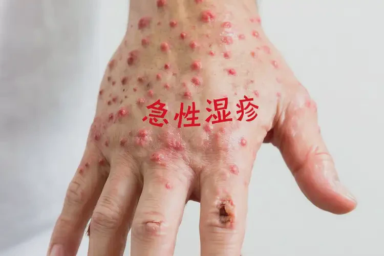 男性手上偶爾起濕疹不管它會自己自愈嗎(圖4)