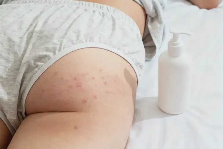 青年人屁股上有濕疹不管它會自己好嗎(圖2)