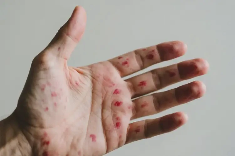 男性手上經(jīng)常長濕疹不管它會(huì)自己痊愈嗎(圖4)