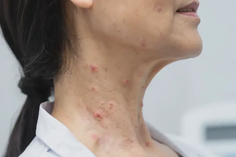 女生脖子偶尔起湿疹不管它会自己好吗(图4)