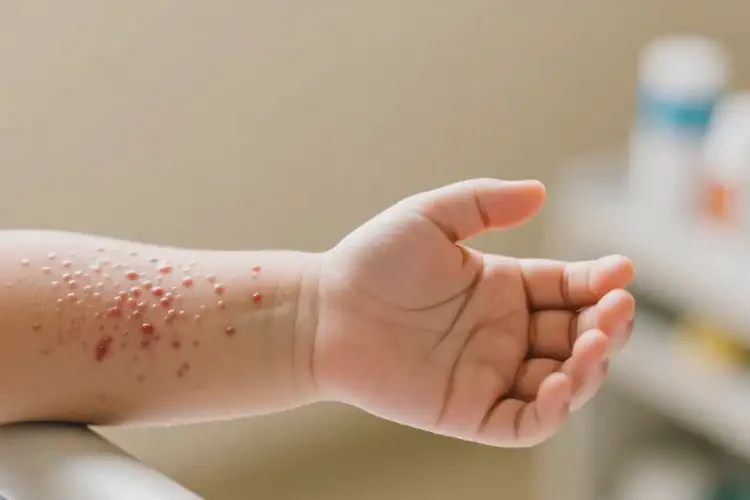 兒童手臂起濕疹不管它會(huì)自己好嗎(圖3)