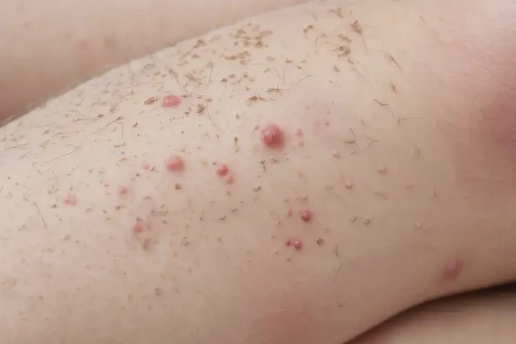 小學(xué)生大腿起濕疹能靠自己自愈嗎(圖4)