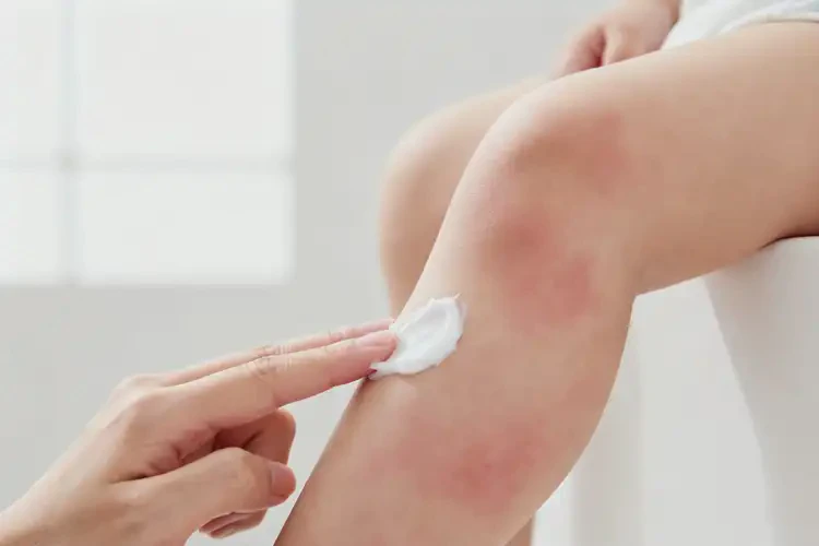 嬰兒小腿偶爾長濕疹能夠徹底治愈嗎(圖2)