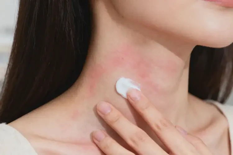 哺乳期媽媽脖子上偶爾長(zhǎng)濕疹能徹底自愈嗎(圖3)