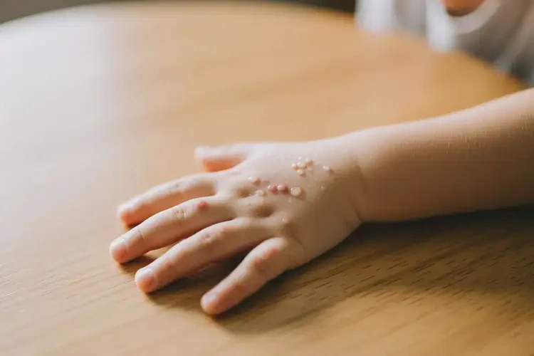 小孩手上偶爾起濕疹能徹底自愈嗎(圖2)