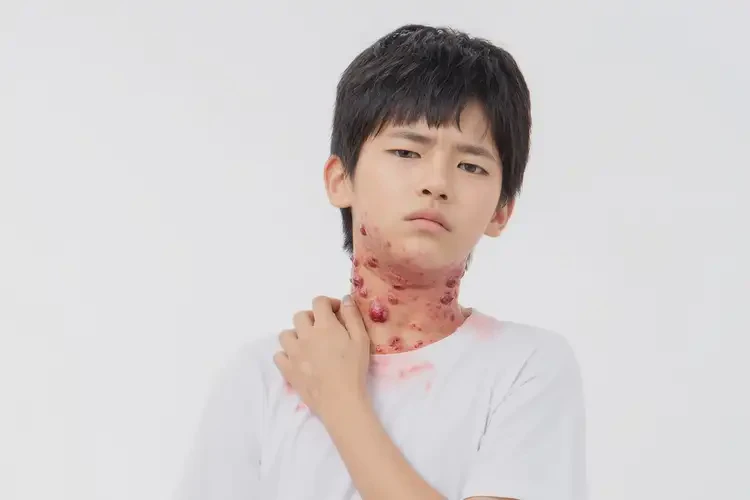 青少年脖子上經(jīng)常起濕疹能靠自己自愈嗎(圖4)