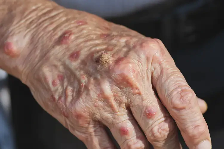 老年人手上經常起濕疹不管它會自己好嗎(圖4)