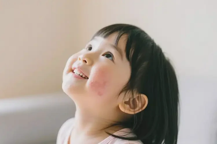 小孩面部容易起濕疹不管它會自己自愈嗎(圖3)