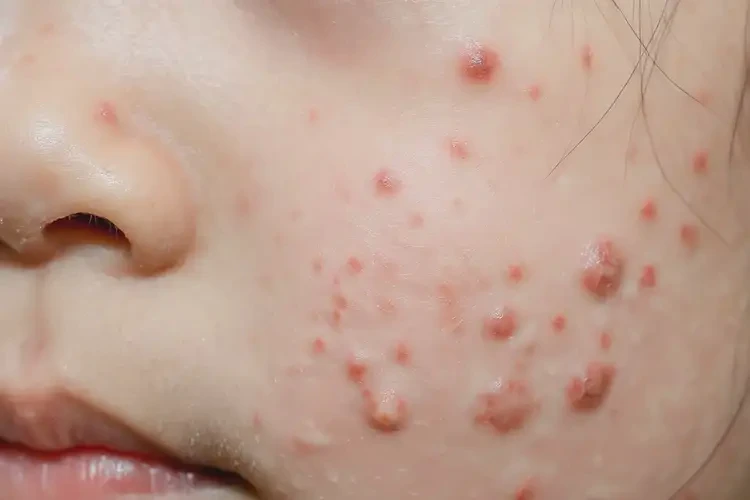 少兒臉上經(jīng)常起濕疹能徹底自愈嗎(圖4)