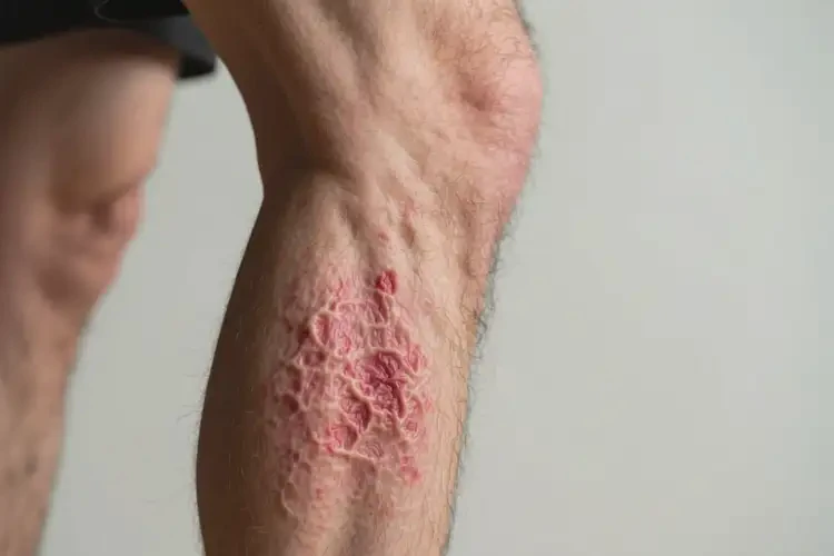 男人小腿上有濕疹不管它會(huì)自己自愈嗎(圖2)