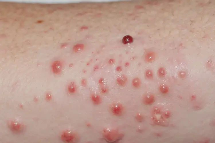 男人手臂上出濕疹能徹底自愈嗎(圖4)