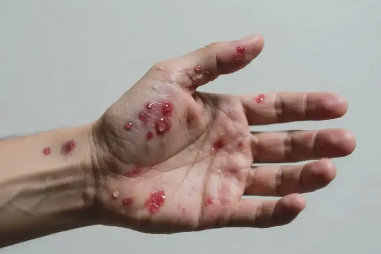 男人手上起濕疹能夠徹底治愈嗎(圖2)