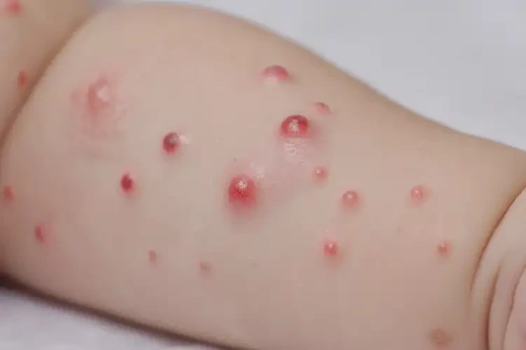 嬰幼兒手臂偶爾起濕疹能靠自己自愈嗎(圖4)