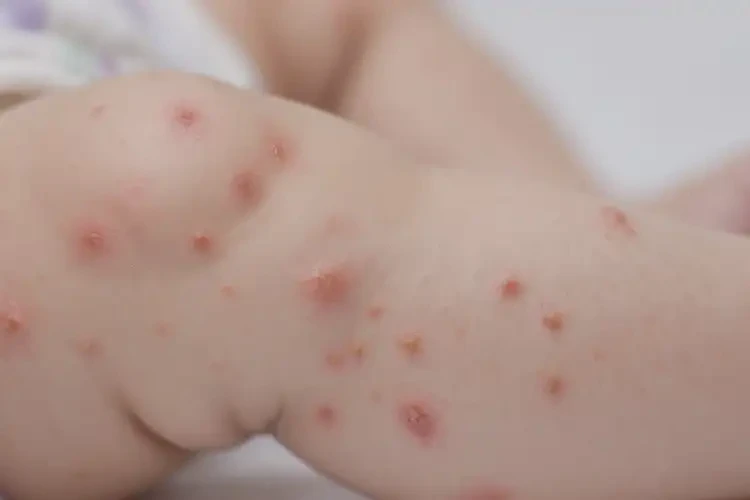 寶寶大腿上長濕疹不管它會自己好嗎(圖4)