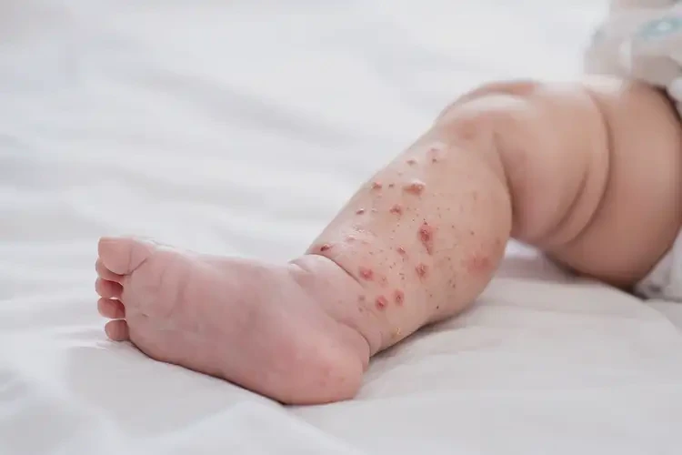 幼兒小腿上有濕疹不管它會自己好嗎(圖3)