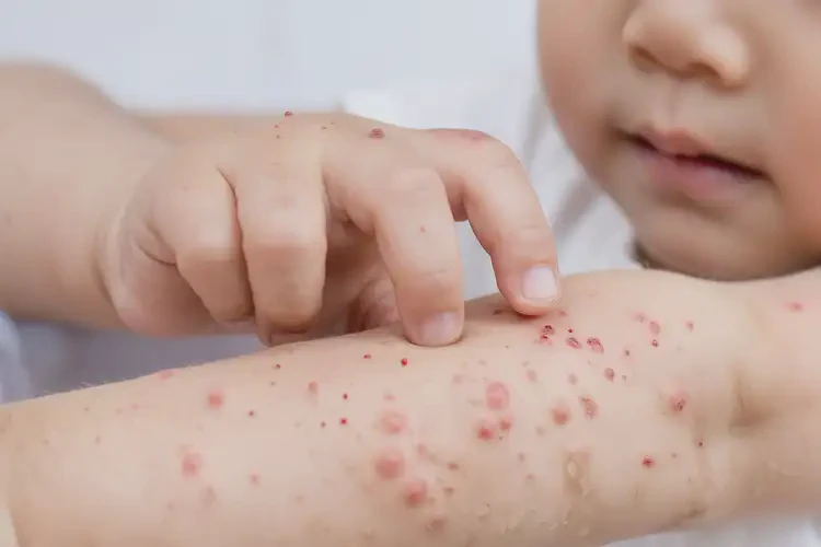 兒童身上容易長濕疹不管它會自己自愈嗎(圖4)