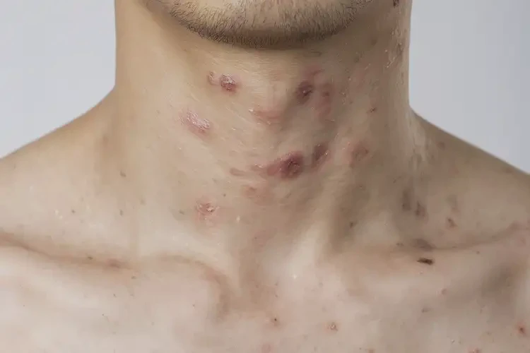 男生脖子上長濕疹能夠徹底治愈嗎(圖4)