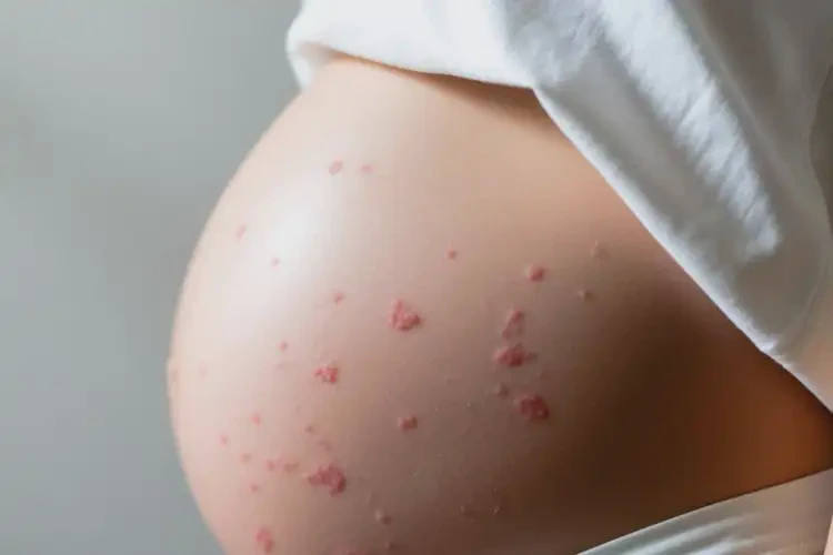 孕婦肚子上經(jīng)常起濕疹不管它會(huì)自己好嗎(圖1)