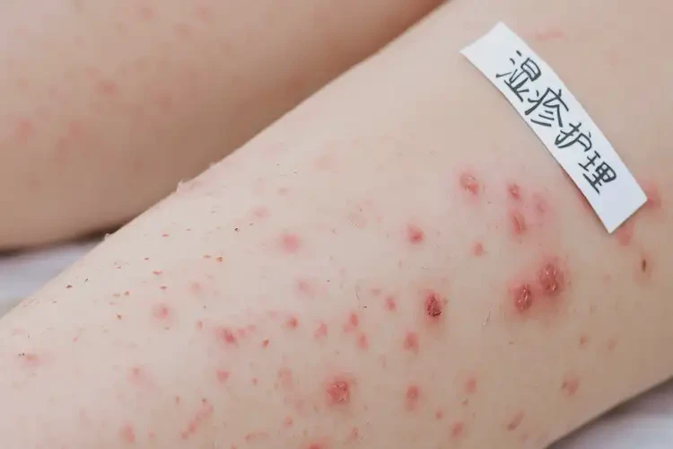 兒童大腿上出濕疹不管它會(huì)自己好嗎(圖4)
