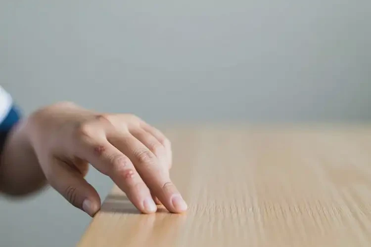 中學(xué)生手上經(jīng)常起濕疹不管它會自己痊愈嗎(圖3)