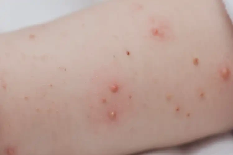 嬰兒屁股上容易起濕疹不管它會自己自愈嗎(圖3)