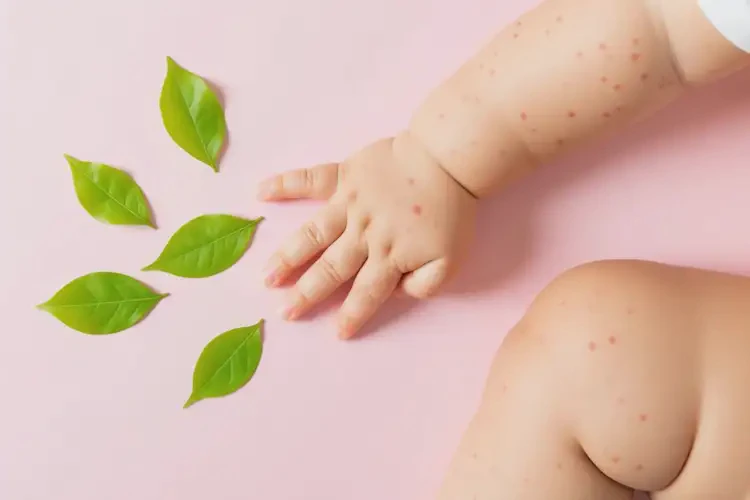 嬰幼兒四肢起濕疹能靠自己自愈嗎(圖3)