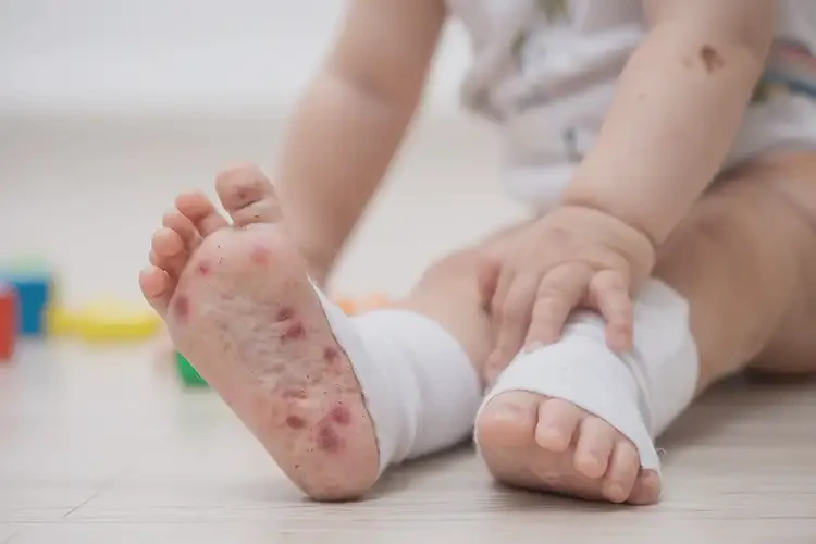 幼儿脚上有湿疹能彻底自愈吗(图2)