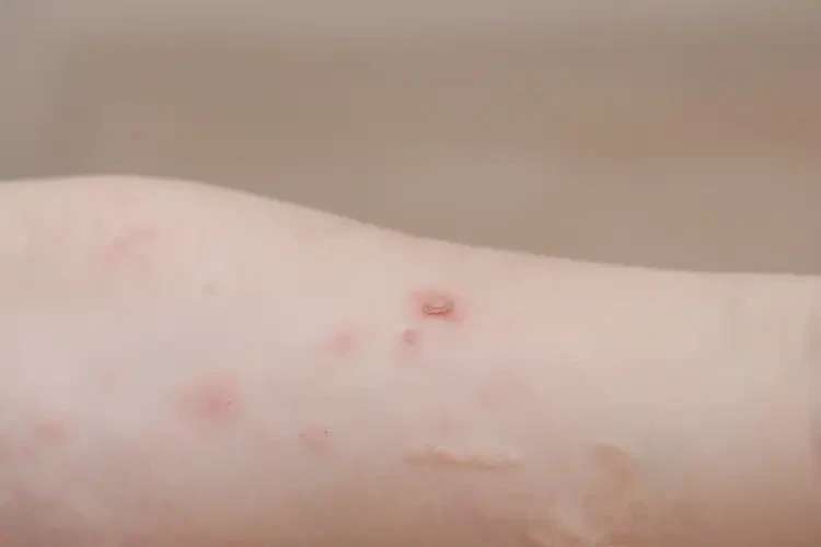 孩子全身偶爾起濕疹不管它會自己痊愈嗎(圖4)