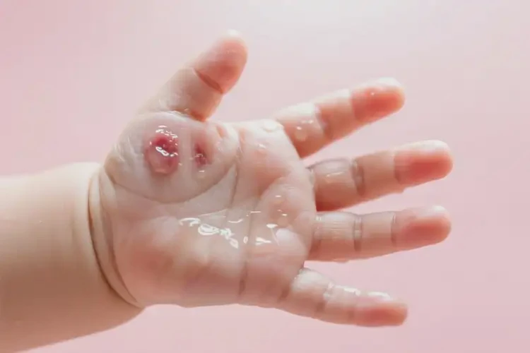 嬰兒手上經(jīng)常長(zhǎng)濕疹能徹底自愈嗎(圖1)