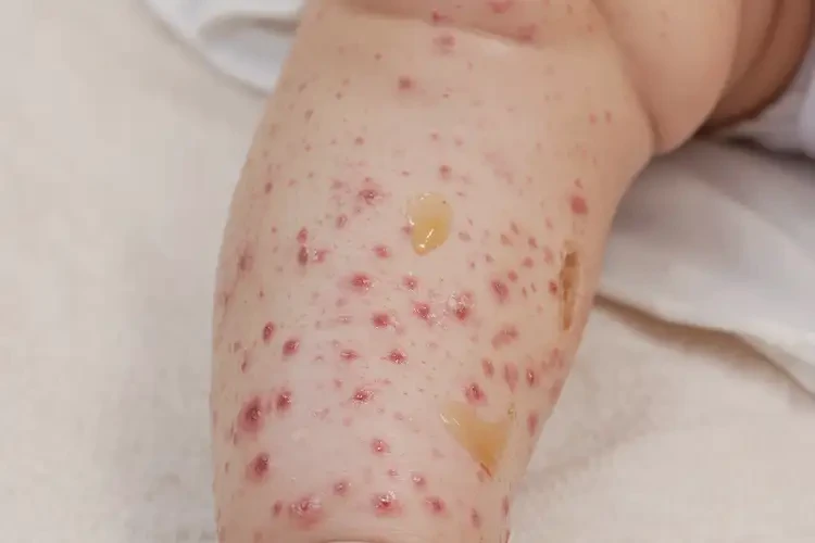 幼兒小腿上有濕疹不管它會自己好嗎(圖2)